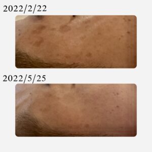 メタジェクト（シミ）